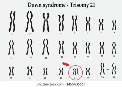 Down syndrome karyotype