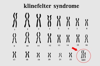 Klinefelter syndrome karyotype