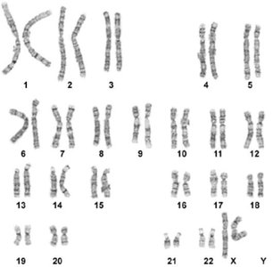 Cri du Chat syndrome deletion on chromosome 5