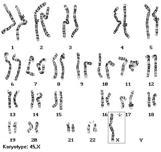 Karyotype of Turner syndrome (45,X)
