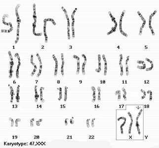 Karyotype of Triple X syndrome (47,XXX)