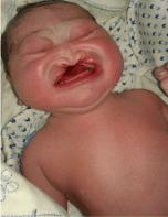 Karyotype of Down syndrome (Trisomy 21)