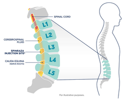Spinraza injection site in spine