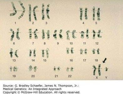 Karyotype of Klinefelter syndrome (47, XXY)