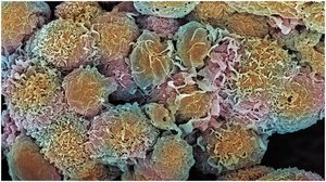 Cancer cells under microscope