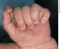 Polydactyly as an example of variable expressivity