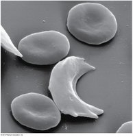 Sickled red blood cells compared to normal cells