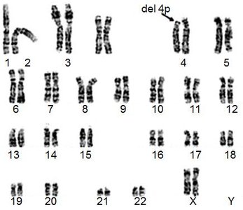Karyotype showing 4p deletion