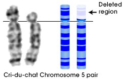 Chromosome 5 deletion (Cri-du-chat Syndrome)