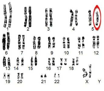 Deleted region in chromosome 5