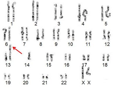 Karyotype of Robertsonian translocation