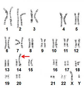 Karyotype of Robertsonian translocation (Familial Patau Syndrome)