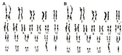 Karyotype showing Pallister-Killian syndrome