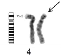 Chromosome 4 deletion (Wolf-Hirschhorn Syndrome)