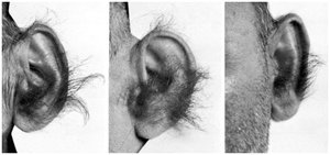 Photographs of ears with excessive hair, proposed as a Y-linked trait