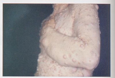 Neurofibromatosis: strong expressivity example