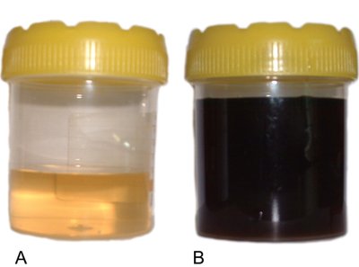 Normal and black urine samples, illustrating alkaptonuria