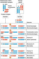 Familial Down syndrome due to Robertsonian translocation