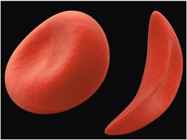 Normal and sickle-shaped erythrocytes