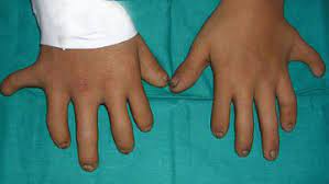 Ellis-van Creveld syndrome, a genetic disorder more common in Amish