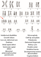 Karyotype and symptoms of Patau syndrome