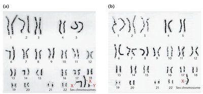 Karyotypes of Klinefelter and Turner syndromes