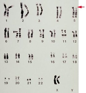 Karyotype showing deletion on chromosome 5