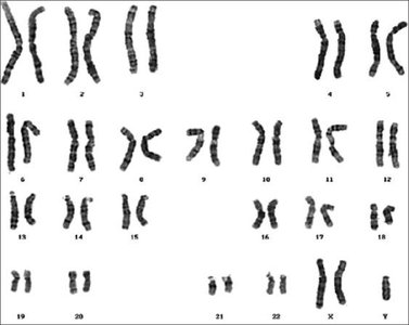 Human karyotype showing chromosomal abnormalities