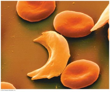Sickle-shaped red blood cell