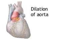Hand showing Marfan syndrome features