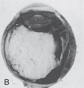 Retinoblastoma tumor