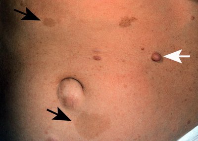 Neurofibromatosis skin features