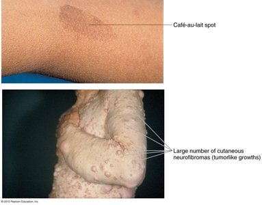 Café-au-lait spot and neurofibromas