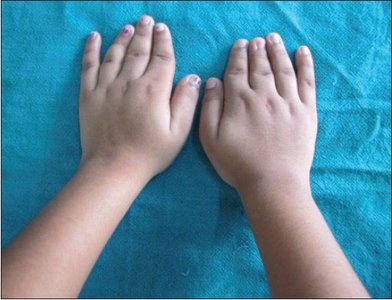 Brachydactyly in humans