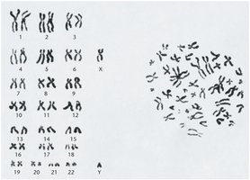 Karyotype image of human chromosomes at metaphase