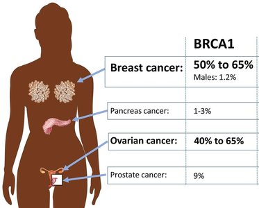 BRCA1 mutation and cancer risk