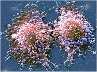 Electron micrograph of dividing cancer cells