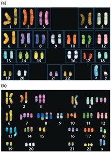 Karyotype of normal and cancer cells showing chromosomal abnormalities
