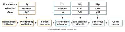 Model for the multistep development of colon cancer