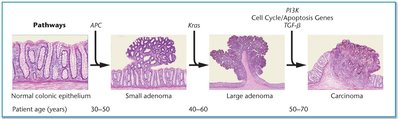 Histological progression of colon cancer