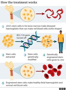 How Casgevy works: stem cell extraction, CRISPR modification, transfusion