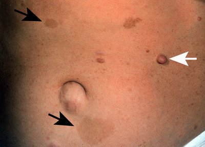 Neurofibromatosis type 1 skin features