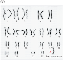 Turner syndrome karyotype