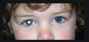 Child with bilateral retinoblastoma