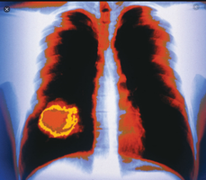 Lung tumor in chest X-ray
