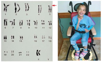 Karyotype and photograph of a child with cri du chat syndrome
