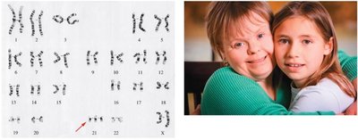 Karyotype and photograph of a child with Down syndrome