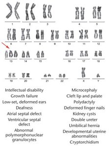 Karyotype and phenotypic description of Patau syndrome