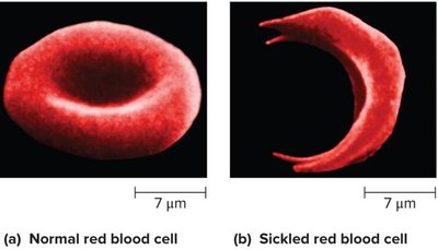 Normal and sickled red blood cells