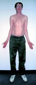 Person with Marfan syndrome